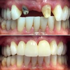 Dental bridges literally bridge the gap created by one or more missing teeth. Dental Bridge Front Teeth Before After Images Video