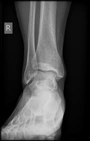 Image result for Ankle XRay
