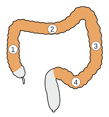 article in german hellmig s(1), stüber e, schulte c, katsoulis s, schreiber s, fölsch ur. Colon Sigmoideum Wikipedia