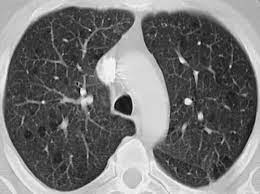 Lymphangioleiomyomatosis Radiologic Pathologic Correlation Radiographics