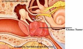 Image result for Glomus tumor