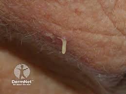 Image result for cornu cutaneum)