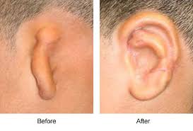 Pin By Linda Vaden On Plastic Surgery Types Of Plastic Surgery Plastic Surgery Surgery