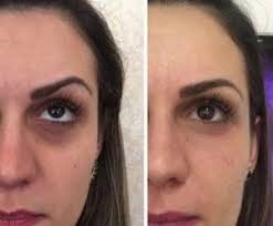 There are many reasons on why not to get a tattoo under your eye for dark circles. Wake Up To Makeup Naples Permanent Makeup Tattoo Removal More
