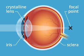 Describe how the light is interacting with the lens. Presbyopia Symptoms Treatment Definition