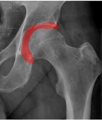 Image result for Hip Labral Tear