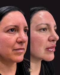 New Service Alert 🚨 Cellenis Derma is a regenerative aesthetic treatment  that uses Platelet-Rich Plasma (PRP) derived from the patient's own blood  to promote skin rejuvenation, improve texture, and reduce signs of