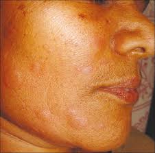 You will learn following functions : Recurrent Facial Urticaria Following Herpes Simplex Labialis Zawar V Godse K Indian J Dermatol