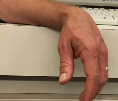 Image result for Paresthesia