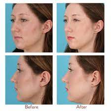 Human nasal volume, linear distance and area increase as we age, and the nasal tip angle droops, or appears to, as we age. How Long Does Your Nose Continue To Change After Rhinoplasty