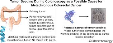 General causes while many different factors can lead to colon cancer, the exact cause is unknown. Tumor Seeding During Colonoscopy As A Possible Cause For Metachronous Colorectal Cancer Gastroenterology