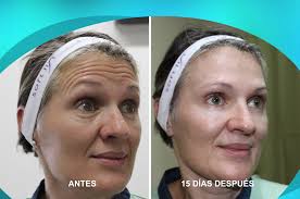 And botox antes y despues is no exception. Clinica Integral Cordero Aplicacion De Toxina Botulinica Botox Y Xeomin