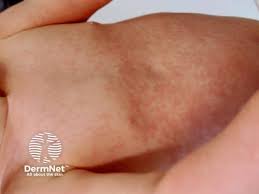 Image result for Rubella