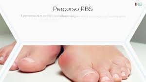 Il piede è una struttura anatomica sulla quale grava tutto il peso del corpo. Un Nuovo Intervento Per L Alluce Valgo La Tecnica Pbs