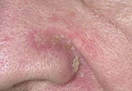 Dry Skin Around Nose Crease Flaking White Dry Skin On Nose Corner Dry Skin Remedies Dry Flaky Skin Dry Hand Skin