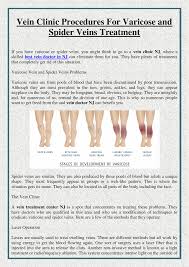 This was amazing to learn because i really hated mine :( please if you try this comment below how it worked for you thanks. Vein Clinic Procedures For Varicose And Spider Veins Treatment