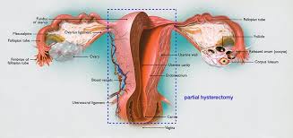 Signs and symptoms of ovarian cancer may include: What Happens To Your Body After A Hysterectomy What To Expect Cigc