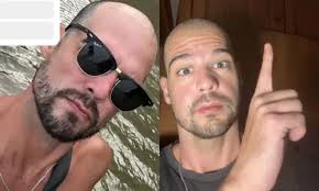 Calvo do Casamento às Cegas faz transplante capilar; veja mudança