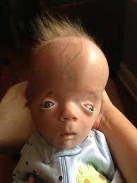 Boy Born With Unique Genetic Disorder Called Miracle Six Years Later