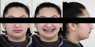 Orthodontic-surgical treatment of skeletal class II malocclusion: A case  report