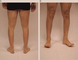 Image result for Myopathy