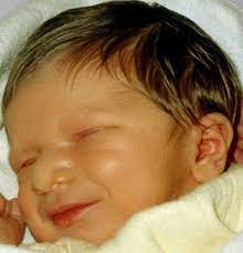 Figure 1 Newborn Male With Pitt Hopkins Syndrome Genereviews Ncbi Bookshelf