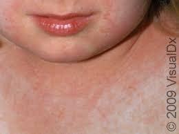 Image result for Scarlet Fever