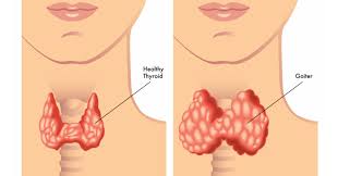 Thyroid problems malayalam #healthtips #adamsworldjasmijinna thyroid is a small gland in your neck that thyroid home remedy in malayalam, avoid these 5 mistakes that you do and improve your. 5 Foods That Can Cause Hypothyroidism Psychology Today
