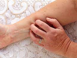 Itchy Skin Threatens Ckd Patients Quality Of Life Medpage Today
