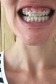 Your dental retainer questions answered. Pin On Adult Braces Before After Cosmetic Dentistry