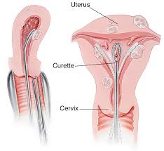 Learn about treatment, causes, stages, surgery, and diagnosis. Dilatation And Curettage Healthdirect