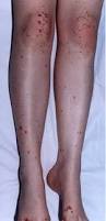 Image result for Vasculitis
