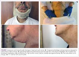 Localized colon cancer has an average 90% survival rate. Prehabilitation For Lymphedema In Head And Neck Cancer Patients At A Community Cancer Center Mdedge Hematology And Oncology
