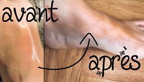 Cicatrices Elles Peuvent Partir Et Voici Comment Vergetures Acnes Blessures 179 Acne Vergetures Cicatrice