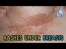 Image result for heat rash under breasts