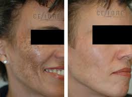 The cream combines 2% hydroquinone with 6% glycolic and lactic acid to exfoliate and lighten the skin effectively. Is Hydroquinone Safe