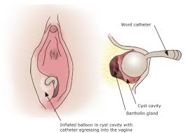 Image result for Bartholin's gland abscess