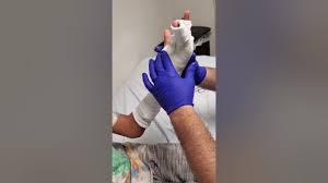 Image result for Ulnar Gutter Cast