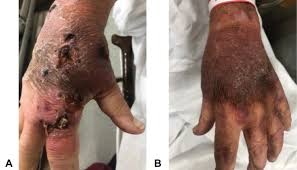 Nathalie quiroz1, janeth del pilar villanueva2, edgar andrés lozano3. Topical Treatment For Cutaneous Mucormycosis Of The Upper Extremity Journal Of Hand Surgery
