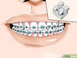 Understanding how to put on these rubber bands is important to wearing braces, as well as helping preserve the hardware of the braces. How To Connect A Rubber Band To Your Braces 12 Steps