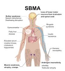 Image result for Progressive Bulbar Paralysis