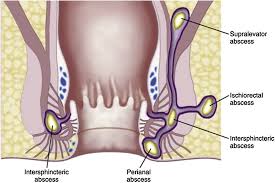 Image result for Intersphincteric Abscess