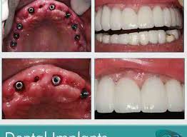 Maybe you would like to learn more about one of these? How Much To Get Dental Implants Dental News Network