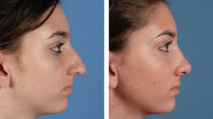 Check spelling or type a new query. Before After Photos Plastic Surgery Ut Southwestern Medical Center