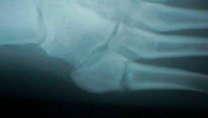 The jones fracture surgery generally involves the placement of plates or screws down the shaft of the fifth metatarsal bone. Jones Fracture Faqs