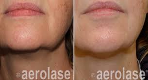 Even if you have to age, you don't have to look like you've been injecting drano into your. How To Get Rid Of A Double Chin Or Turkey Neck Without Surgery Koru Medical Spa