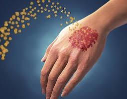 как избавиться от экземы на руках в домашних условиях Lechenie Psoriaza Prichiny Simptomy I Metody Lecheniya