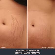 Microneedling RF Radio Frequency Microneedling Novuskinsexiezpix Web Porn