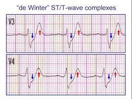 Patient:innen mit solchen ekgs und passender symptomatik brauchen potentiell dringend eine herzkatheteruntersuchung. Dewinter S T Waves