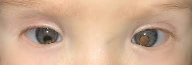 Image result for Coloboma